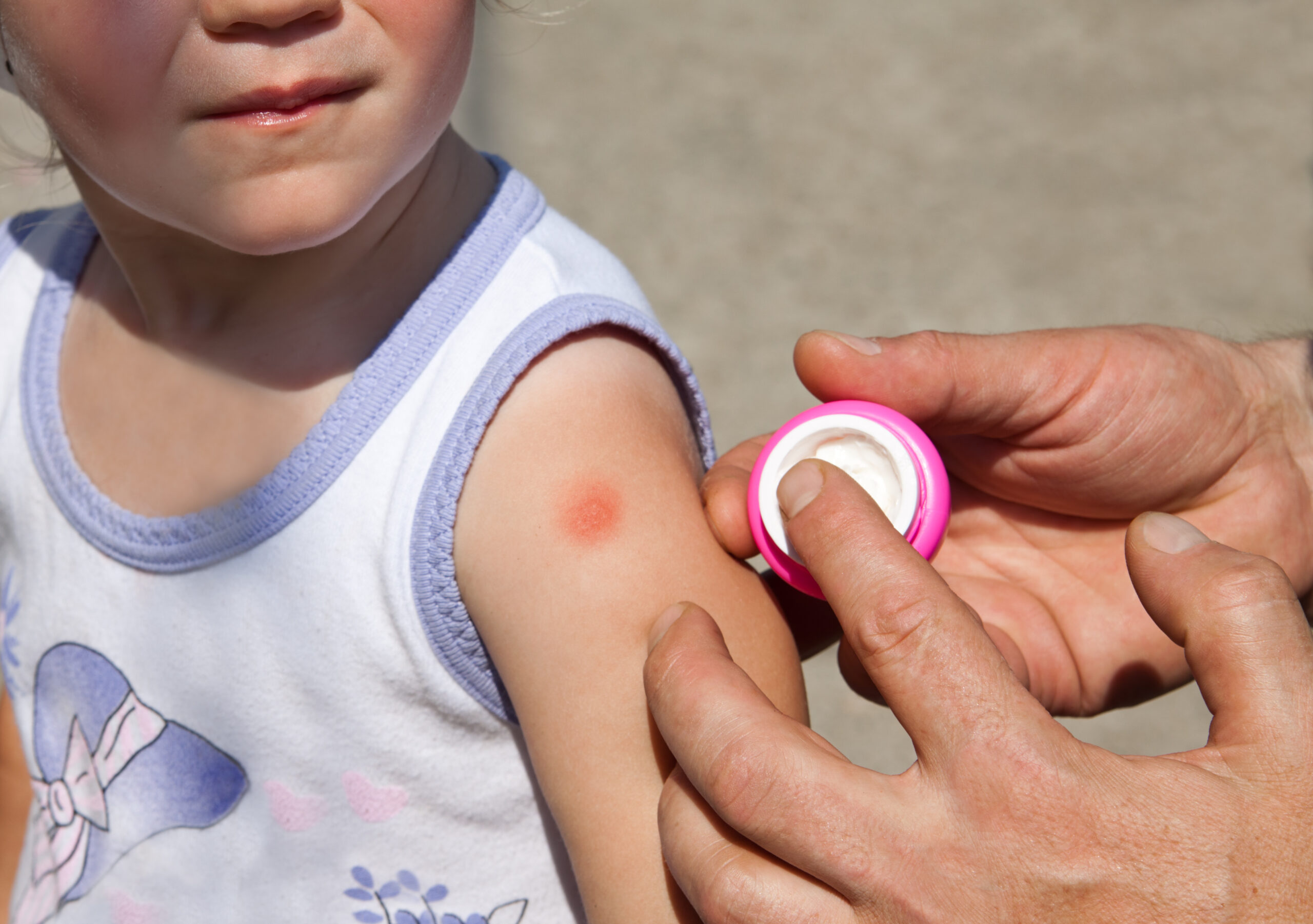 treating a child's arm with ointment